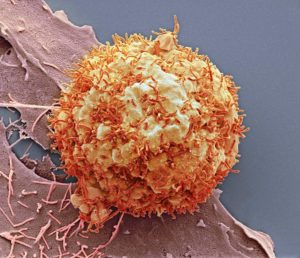 Carcinoma nel fegato