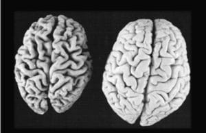 Italiani all'estero e ricerca sull'Alzheimer