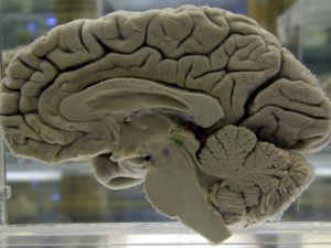 Alzheimer può essere legato all'herpesvirus