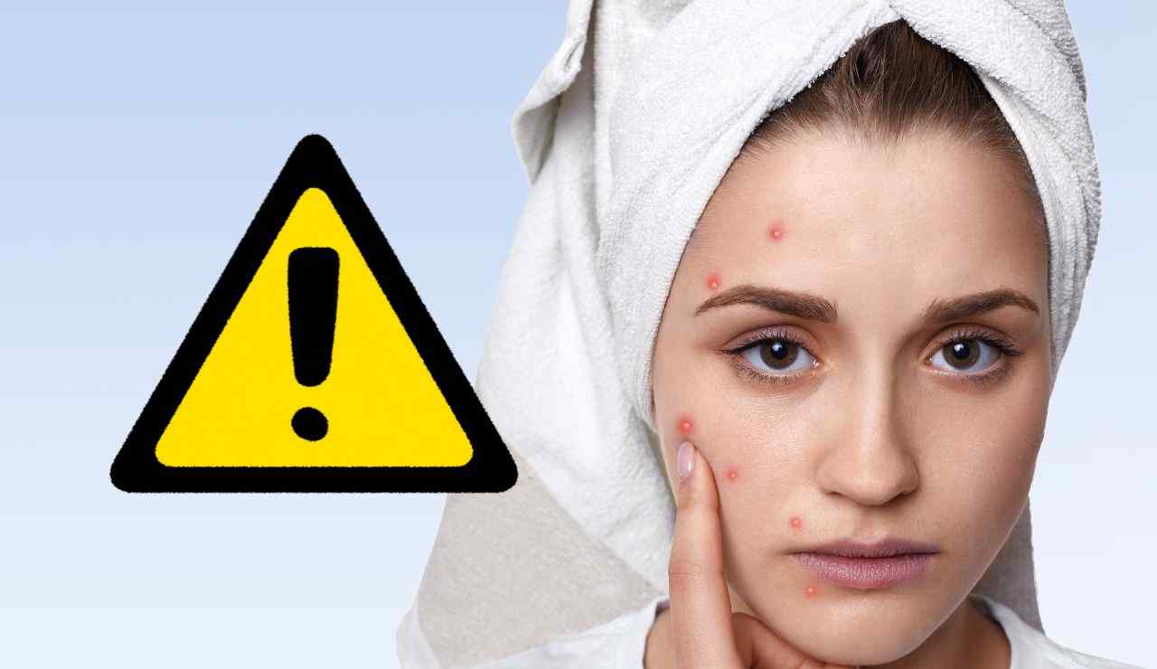 Pericolo acne